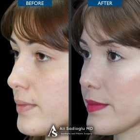 Vorher-nachher-Rhinoplastik-Ergebnis bei Dr. Safa Manav Clinic, verbesserte Nasenform