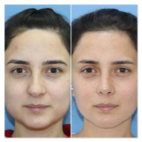 Vorher-nachher-Ergebnis der Nasenkorrektur in der Dr. Safa Manav Klinik, Nasenform verbessert