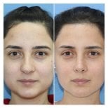 Vorher-nachher-Ergebnis der Nasenkorrektur in der Dr. Safa Manav Klinik, Nasenform verbessert