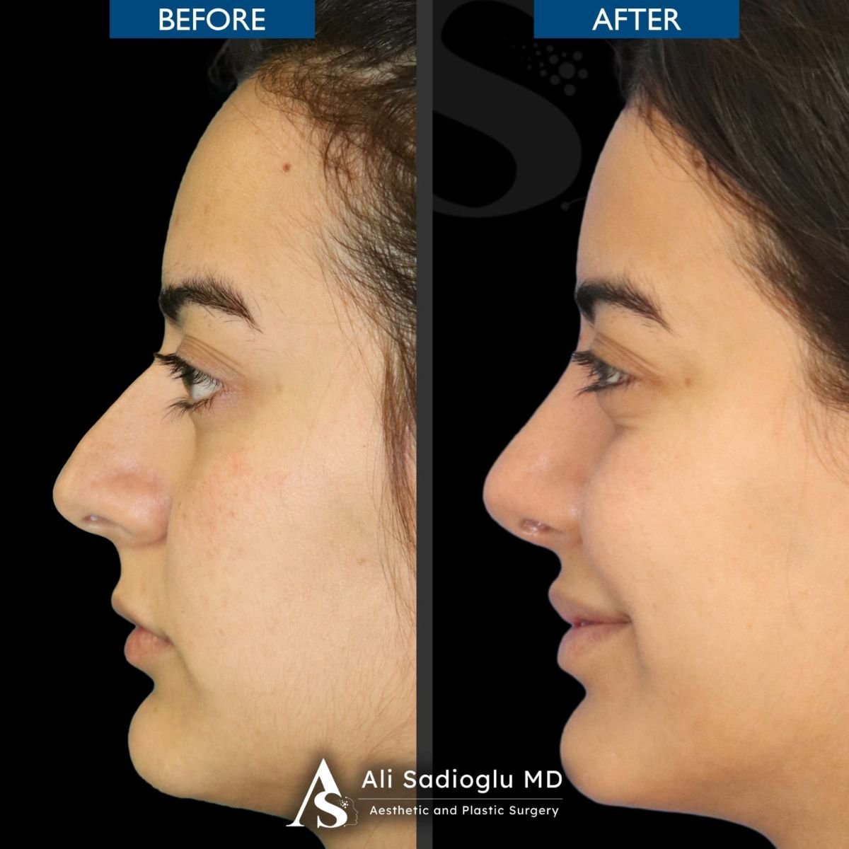 Vorher-nachher-Rhinoplastik-Ergebnis in der Dr. Safa Manav Klinik, verbesserte Nasenform