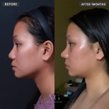 Resultados de rinoplastia antes y después en VG Plastic Surgery, perfil nasal mejorado