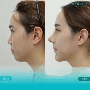 Deep plane facelift before and after results at Wansiri Hospital, visible jawline improvement