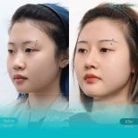 Before and after deep plane facelift result at Wansiri Hospital, visible facial contour lift