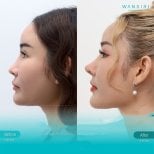 Before and after deep plane facelift results at Wansiri Hospital, visible facial contour lift