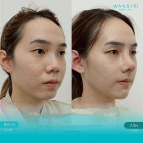 Before and after deep plane facelift results at Wansiri Hospital, visible facial contour lift