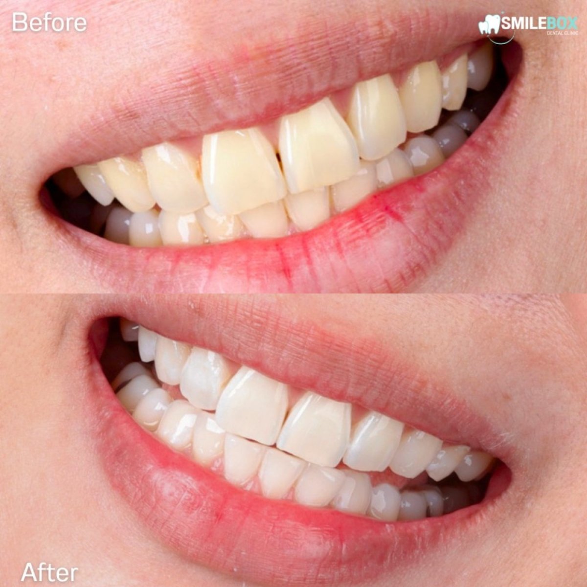 Resultados antes y después del blanqueamiento dental láser en SmileBox Dental Clinic - Thonglor