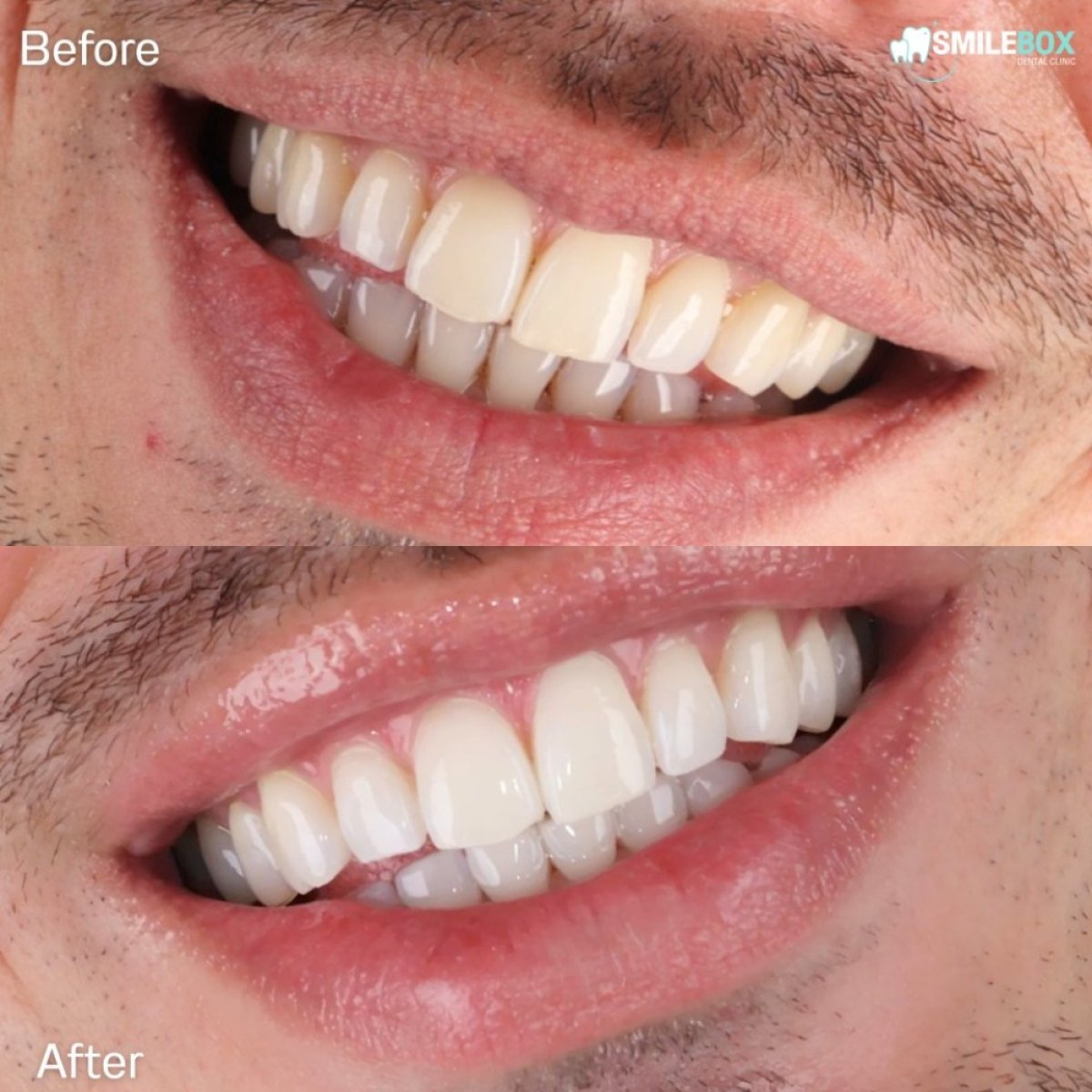 نتائج تبييض الأسنان بالليزر قبل وبعد في SmileBox Dental Clinic - Thonglor, Sukhumvit