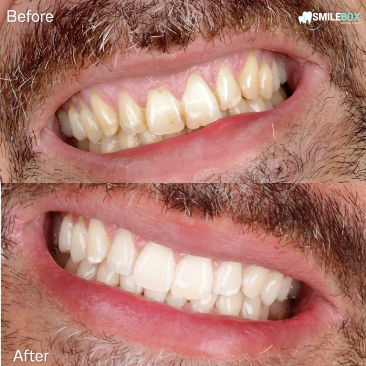 نتيجة تبييض الأسنان بالليزر قبل وبعد في SmileBox Dental Clinic - Thonglor, Sukhumvit