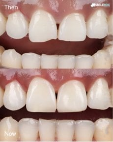 Porcelain veneer before and after results at SmileBox Dental Clinic - Thonglor, Sukhumvit Branch