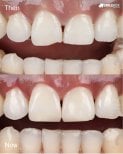 Porcelain veneer before and after results at SmileBox Dental Clinic - Thonglor, Sukhumvit Branch