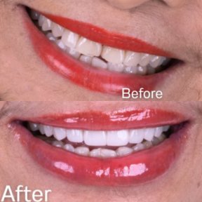 Результати до і після встановлення порцелянових вініров у SmileBox Dental Clinic - Thonglor