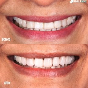 Результаты до и после установки фарфоровых виниров в SmileBox Dental Clinic - Thonglor