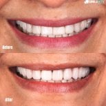 Результаты до и после установки фарфоровых виниров в SmileBox Dental Clinic - Thonglor