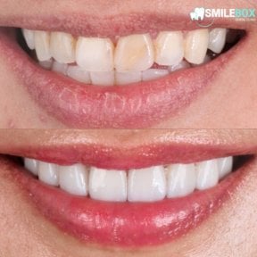 نتائج قبل وبعد قشور البورسلين في SmileBox Dental Clinic - Thonglor، Sukhumvit Branch
