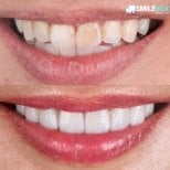 نتائج قبل وبعد قشور البورسلين في SmileBox Dental Clinic - Thonglor، Sukhumvit Branch