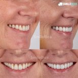 Efekty przed i po licówkach porcelanowych w SmileBox Dental Clinic - Thonglor