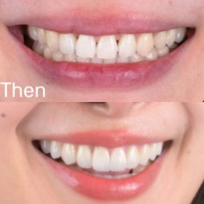 Porcelain veneer before and after results at SmileBox Dental Clinic - Thonglor, Sukhumvit Branch