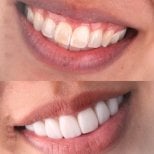 Porcelain veneer before and after results at SmileBox Dental Clinic - Thonglor, Sukhumvit Branch