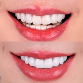 Porcelain veneer before and after results at SmileBox Dental Clinic - Thonglor, Sukhumvit Branch