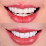 Porcelain veneer before and after results at SmileBox Dental Clinic - Thonglor, Sukhumvit Branch