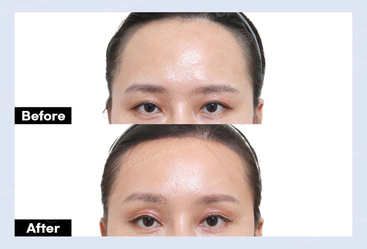 Resultados de blefaroplastia superior antes y después en URBAN Plastic Surgery, mirada mejorada