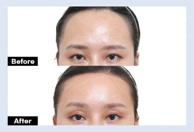 نتائج جراحة الجفن العلوي قبل وبعد في URBAN Plastic Surgery، مظهر عين محسّن