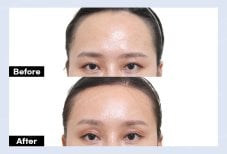 نتائج جراحة الجفن العلوي قبل وبعد في URBAN Plastic Surgery، مظهر عين محسّن