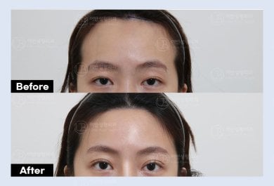 نتائج قبل وبعد جراحة الجفن العلوي في URBAN Plastic Surgery، مظهر عين محسّن