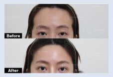 نتائج قبل وبعد جراحة الجفن العلوي في URBAN Plastic Surgery، مظهر عين محسّن