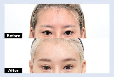 نتائج جراحة الجفن العلوي قبل وبعد في URBAN Plastic Surgery، مظهر عين محسّن