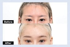 نتائج جراحة الجفن العلوي قبل وبعد في URBAN Plastic Surgery، مظهر عين محسّن