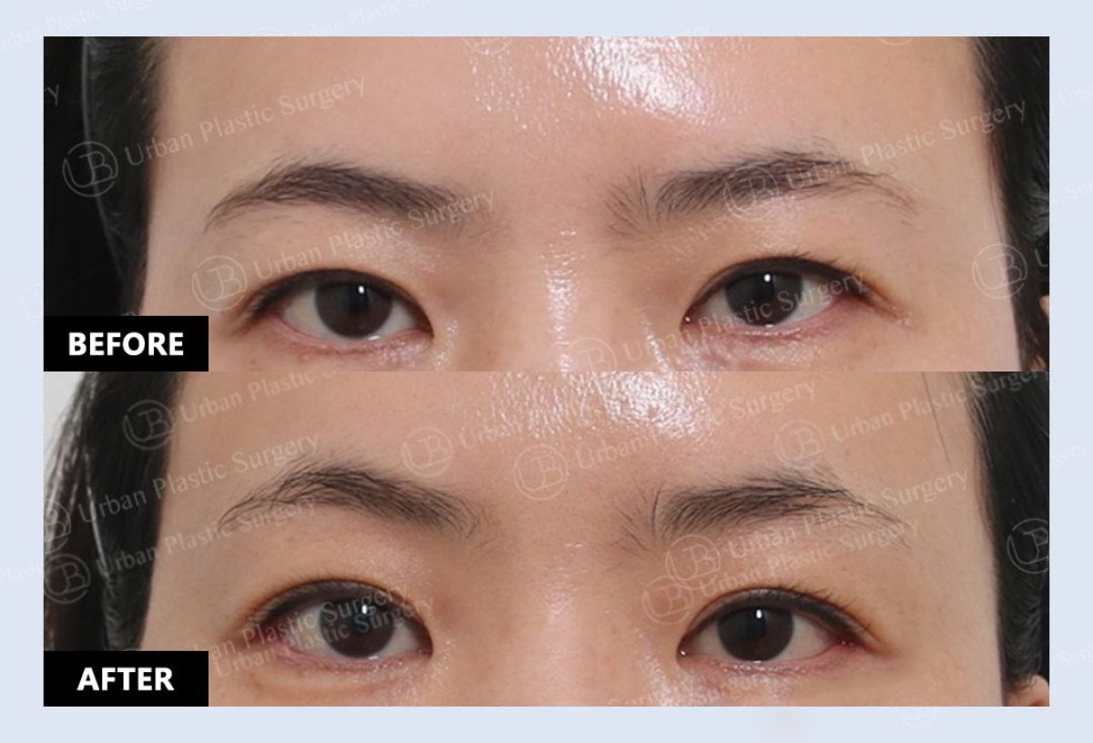Resultados de blefaroplastia superior antes y después en URBAN Plastic Surgery, contorno mejorado