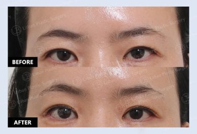 نتائج جراحة الجفن العلوي قبل وبعد في URBAN Plastic Surgery، تحسين شكل العين