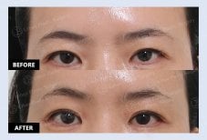 نتائج جراحة الجفن العلوي قبل وبعد في URBAN Plastic Surgery، تحسين شكل العين