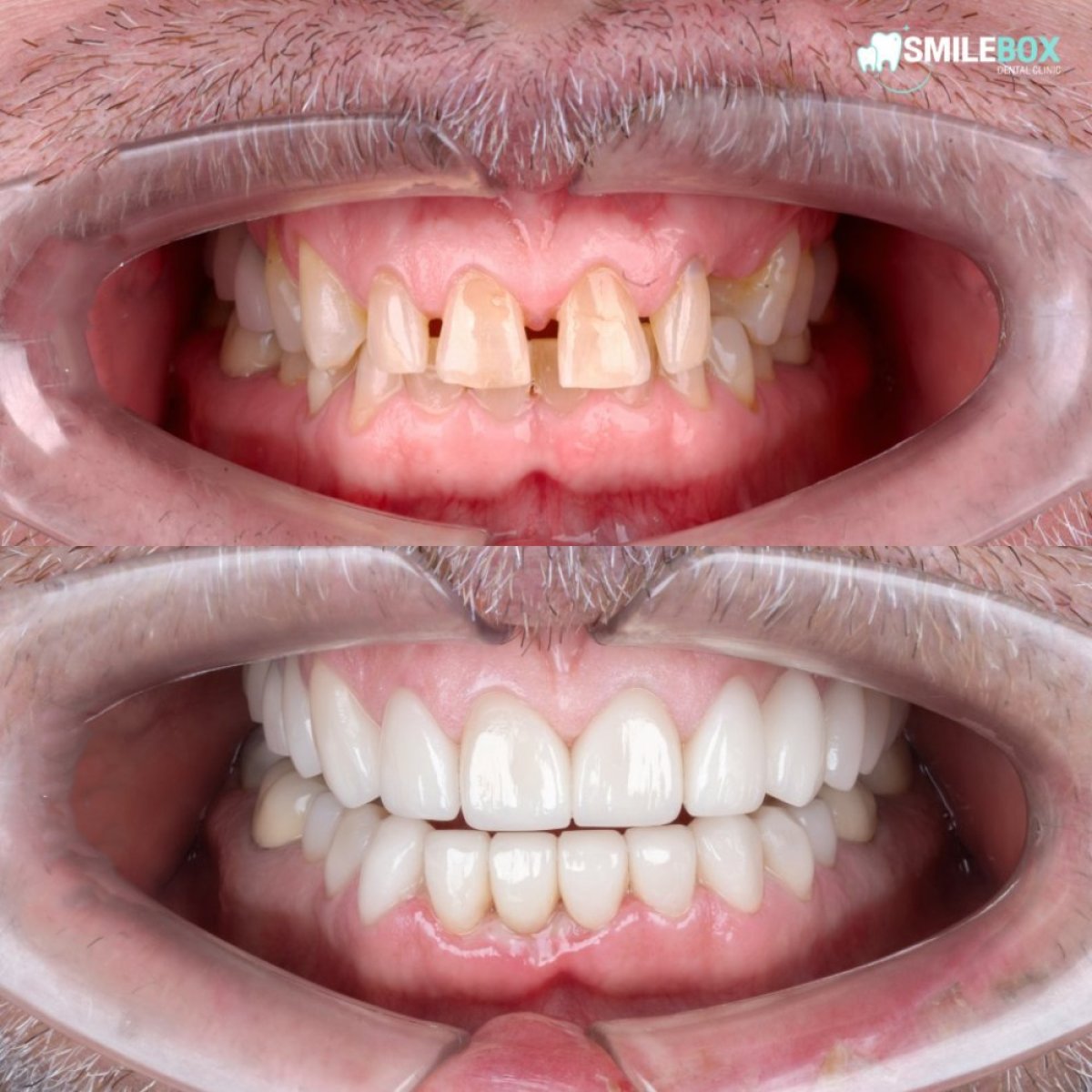 نتائج قبل وبعد تجميل الابتسامة في SmileBox Dental Clinic - Thonglor, Sukhumvit Branch