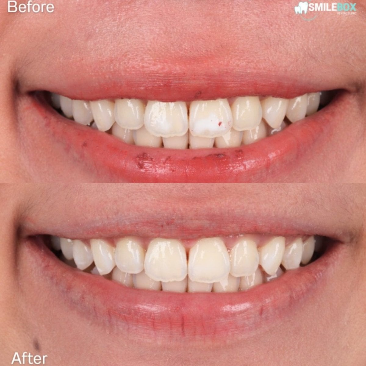 Resultados de blanqueamiento dental láser antes y después en SmileBox Dental Clinic - Thonglor, Sukhumvit