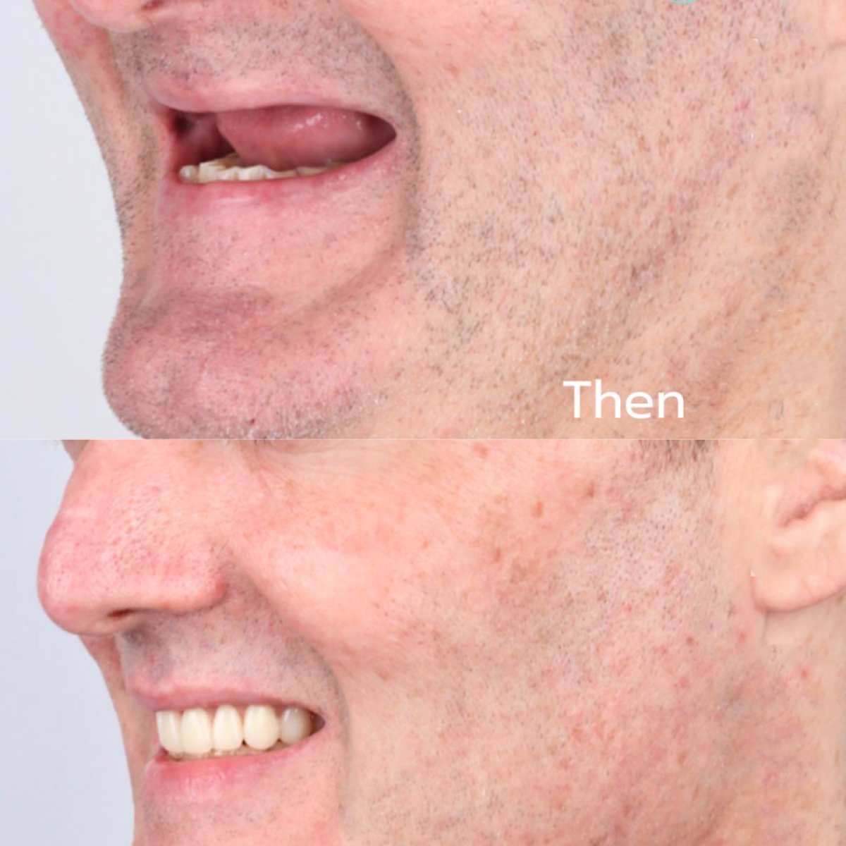 نتائج قبل وبعد طقم الأسنان المدعوم بـ4 غرسات وشريط تيتانيوم CAD/CAM في SmileBox Dental Clinic