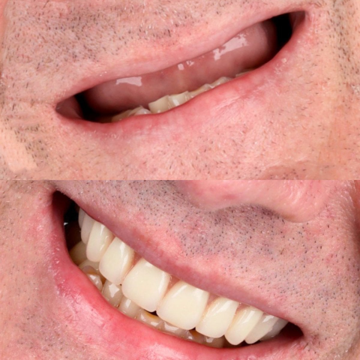 Antes y después de sobredentadura sobre 4 implantes con barra de titanio en SmileBox Dental Clinic