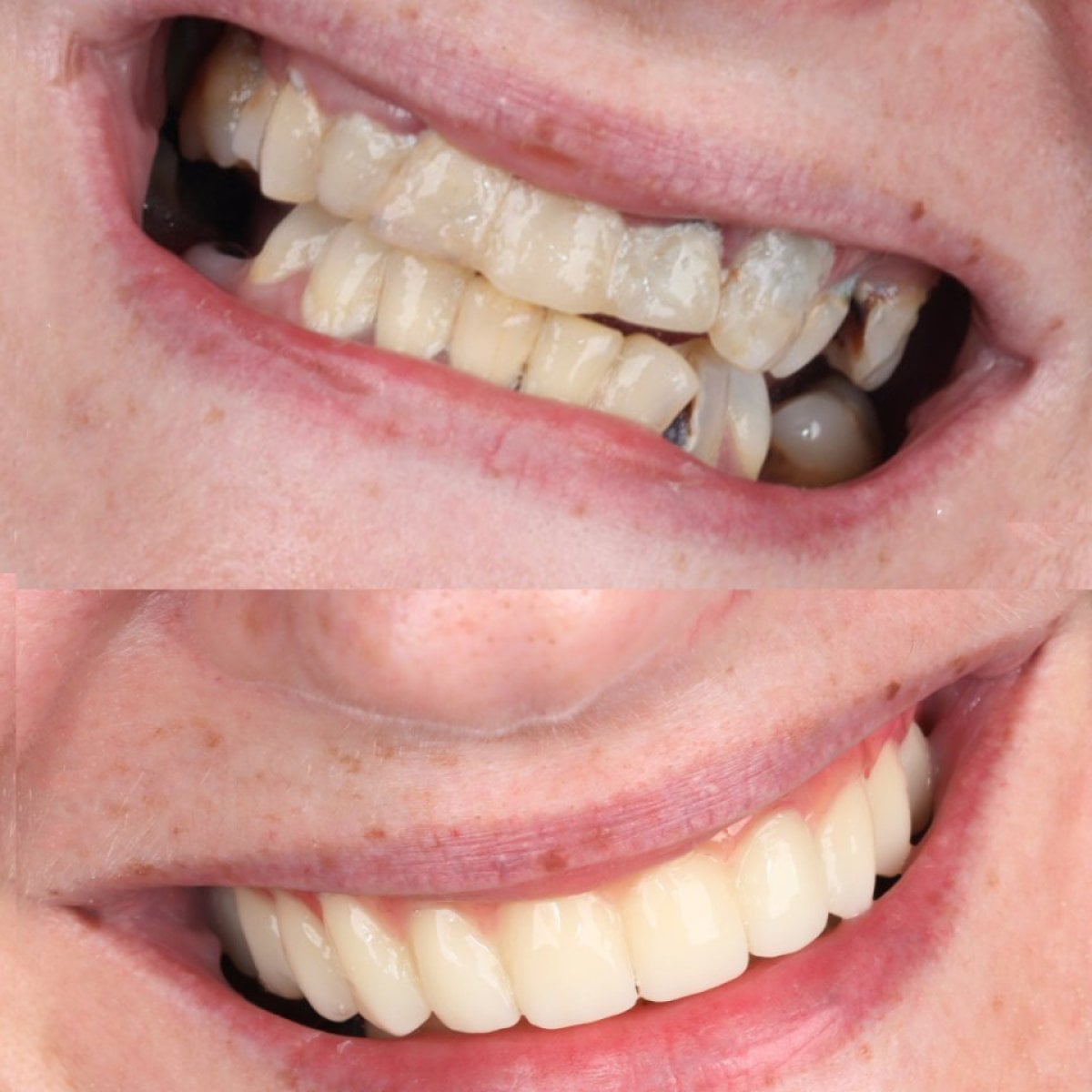 نتيجة قبل وبعد زراعة الأسنان All-on-4 في SmileBox Dental Clinic - Thonglor, Sukhumvit