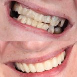 Before and after All-on-4 dental implants result at SmileBox Dental Clinic - Thonglor, Sukhumvit