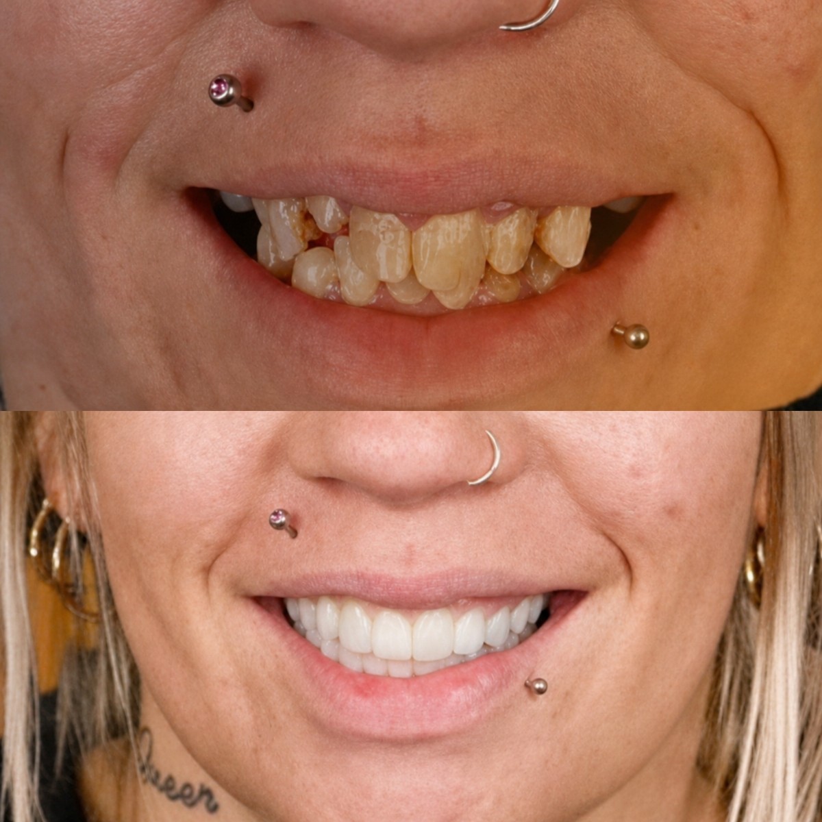 نتيجة قبل وبعد زراعة الأسنان All-on-4 في SmileBox Dental Clinic فرع ثونجلور