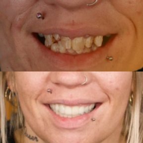 Before and after All-on-4 dental implants result at SmileBox Dental Clinic - Thonglor branch