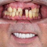 Before and after All-on-4 dental implants result at SmileBox Dental Clinic - Thonglor, Sukhumvit