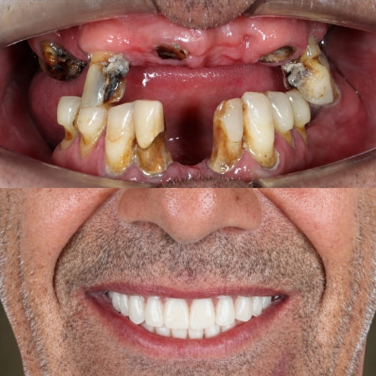Resultado antes y después de implantes All-on-4 en SmileBox Dental Clinic - Thonglor, Sukhumvit