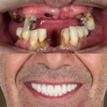 Before and after All-on-4 dental implants result at SmileBox Dental Clinic - Thonglor, Sukhumvit
