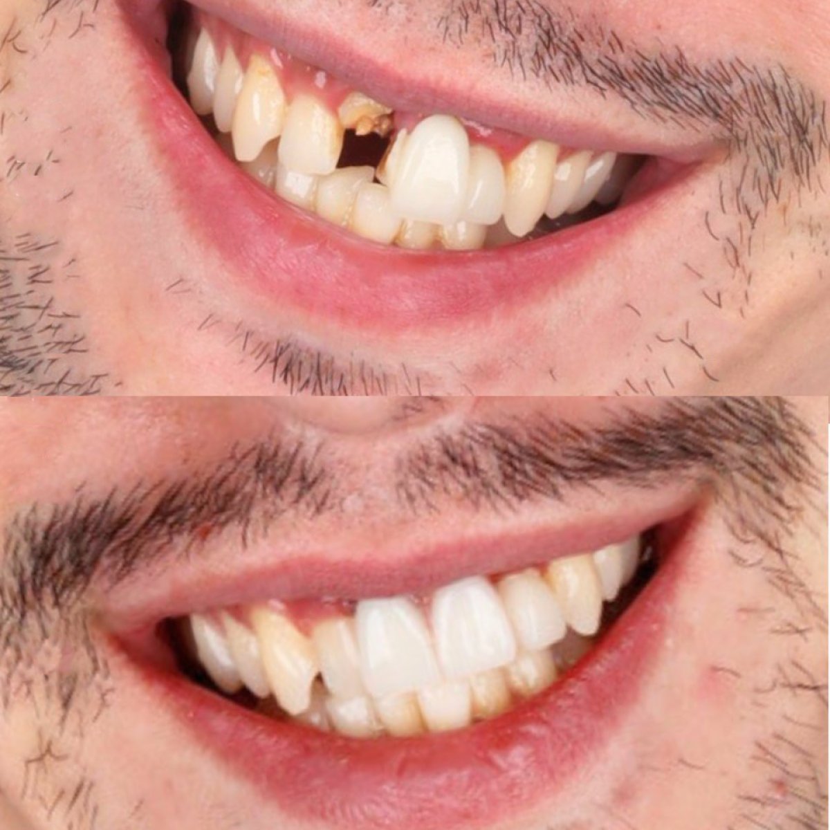 نتيجة زراعة الأسنان قبل وبعد في SmileBox Dental Clinic - Thonglor، ابتسامة محسنة