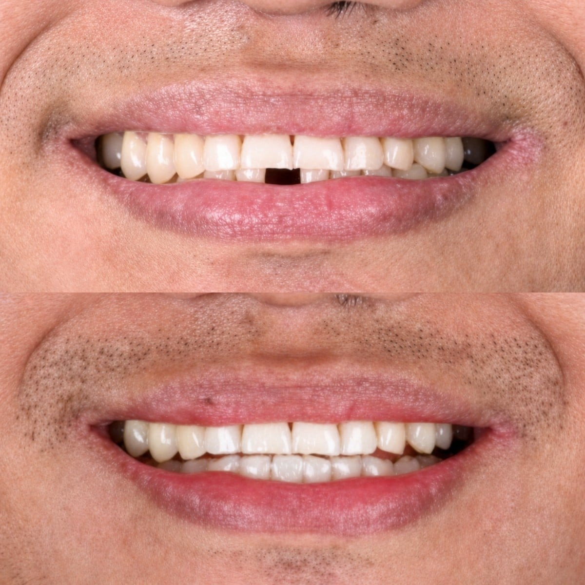 نتائج قبل وبعد زراعة الأسنان في SmileBox Dental Clinic - Thonglor، ابتسامة محسنة