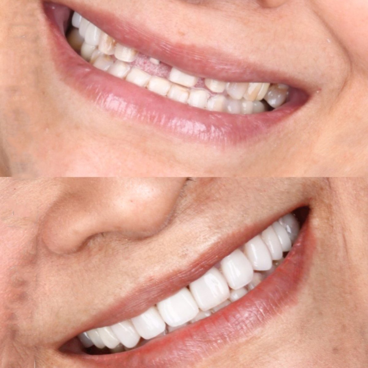 نتائج قبل وبعد زراعة الأسنان في SmileBox Dental Clinic - Thonglor, Sukhumvit Branch