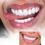 Porcelain veneer before and after results at SmileBox Dental Clinic - Thonglor, Sukhumvit Branch