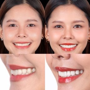 Porcelain veneer before and after results at SmileBox Dental Clinic - Thonglor, Sukhumvit Branch